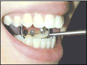 A mirror showing concealed lingual orthodontic appliances
