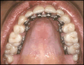 Image showing concealed lingual orthodontic appliances from under the teeth