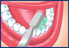 Hold the toothbrush at a 45-degree angle to the teeth.