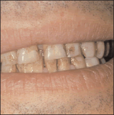 Smoker's teeth before quitting