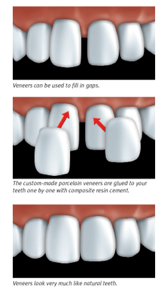 bonding on teeth vs veneers