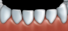 Dental bonding can be used to fix teeth that are chipped