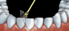 Une pellicule de plastique transparent est placée entre la dent traitée et la dent voisine. La résine composite est appliquée en plusieurs couches.