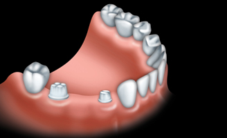 much crown teeth canada