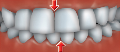 occlusion croise