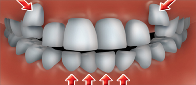 Dents chevauches