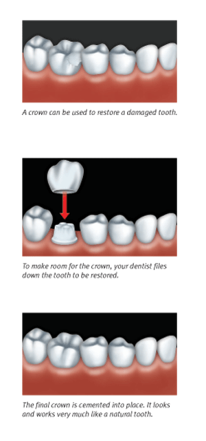 Different types of crowns