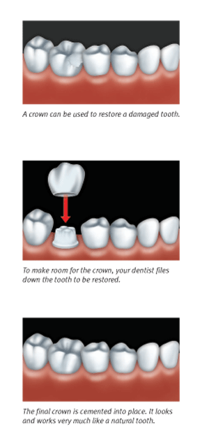 different types of crowns for teeth