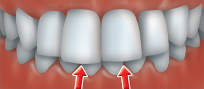 occlusion ferme