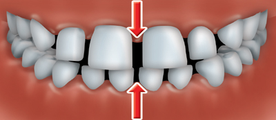 Gaps between teeth