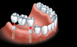 Un pont fixe est solidement fix� aux implants 
dentaires pour remplacer toutes les dents.