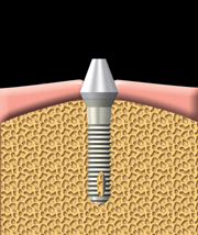 Un pilier est fixé à l'implant. Le pilier relie la dent de remplacement à l'implant.