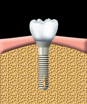 Une dent artificielle est fix�e au pilier.
L'ajustement de la dent artificielle peut n�cessiter plusieurs s�ances.