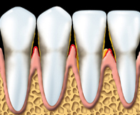 Periodontal 3