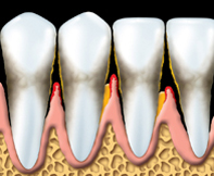 Periodontal 4