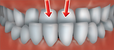 An underbite occurs when the upper teeth fit inside the arch of the lower teeth.
