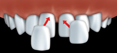 Fabriquées sur mesure, les facettes en porcelaine sont collées à vos dents une à une à l'aide d'un ciment de résine composite.