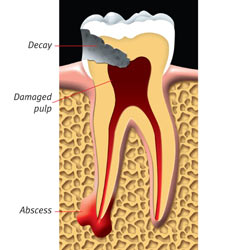 An abscessed tooth