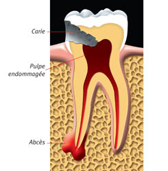 Root Canal 2