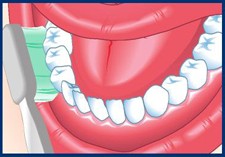 Tenez la brosse à un angle de 45 degrés avec les dents, les poils sous le rebord des gencives, à la base des dents. Puis, dans un mouvement circulaire, massez légèrement à partir de la base. Ne frottez pas. Le brossage trop vigoureux des dents pendant des années peut amener les gencives à se rétrécir et se détacher des dents.