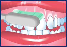 Point the bristles to where the gums and teeth meet