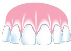 A fixed bridge (or fixed partial denture)