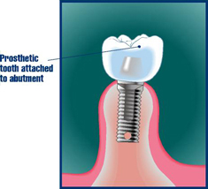 Dental implants