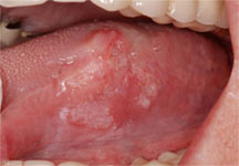 Cancer de la bouche