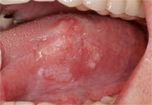 Oral Cancer