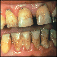 Periodontitis