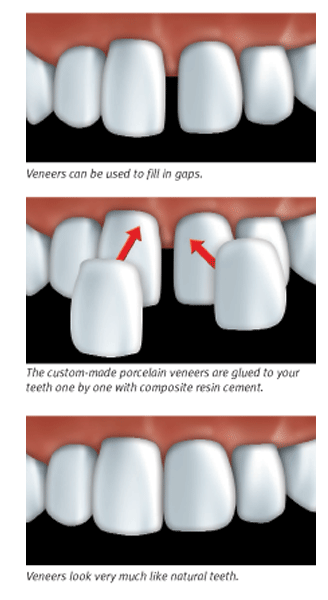 Graphic representation of how porcelain veneers are attached