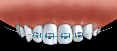 Are you in need of orthodontic treatment & what do you look for in