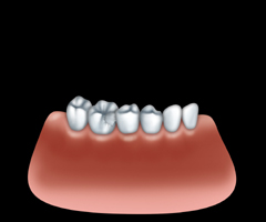 Couronne En Résine Pour Le Traitement Temporaire, Qui Sont Utilisés Dans  Les Cas Où Le Patient Doit Repartir Avec Les Dents Meulé Du Dentiste.  Ceux-ci Ont Un Rôle Protecteur Sur Les Dents