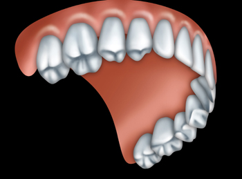 Full Upper Denture