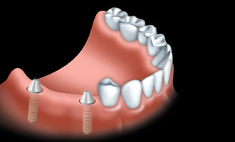 Un pont fixe est solidement fix� aux implants
dentaires pour remplacer une ou plusieurs dents.