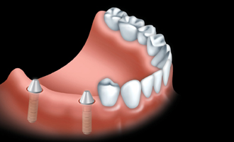 Un pont fixe est solidement fix aux implants
dentaires pour remplacer une ou plusieurs dents.