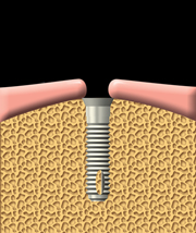 A dental implant is inserted into the jawbone