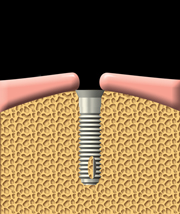 Affordable dental Implants, cheap implant vancouver, #cheapImplant, #Dentalimplant, #affordableimplant