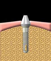 Un pilier est fix  l'implant. Le pilier relie la dent de remplacement  l'implant.