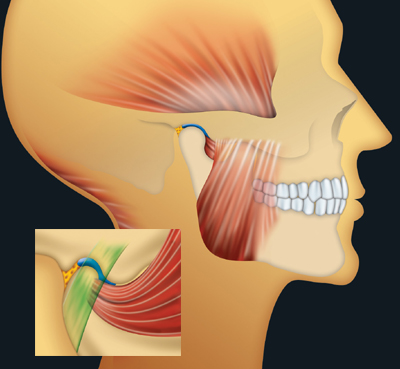 Traitement des articulations (ATM) - Plaque articulaire