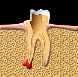 The damaged pulp is removed