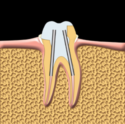 The tooth is prepared for a crown. Posts are used to help support the crown.