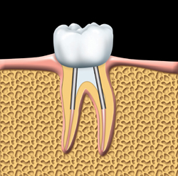 The crown is cemented into place